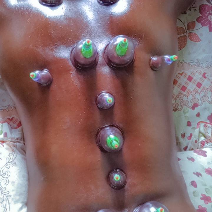 Cupping therapy