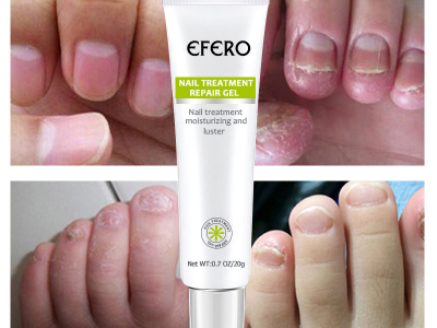 Nails treatment gel