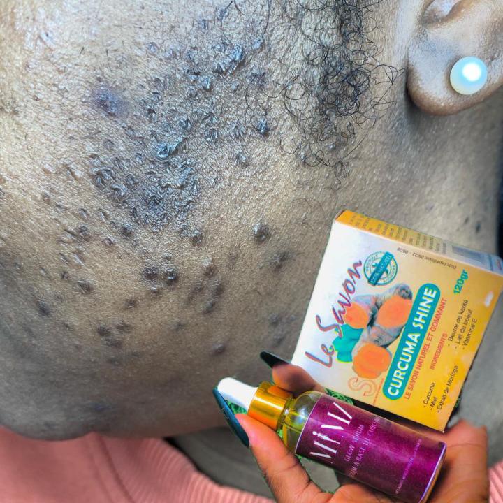 Acne & dark spot treatment