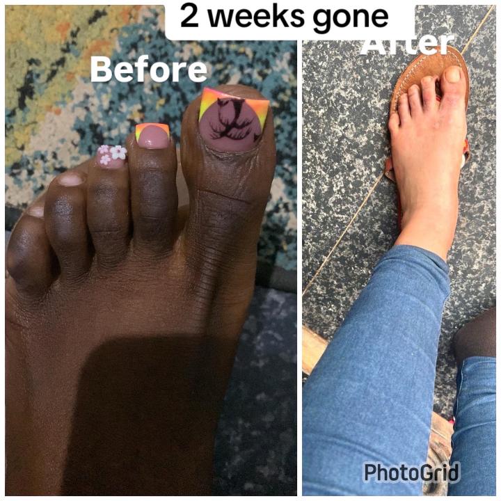 Knuckles Treatment