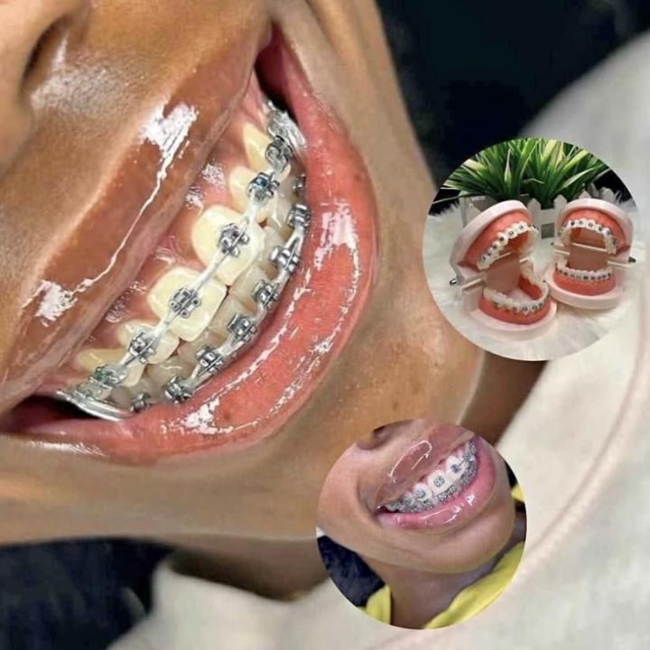 Dental braces